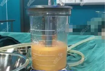 陵水360度水动力吸脂费用多少钱？